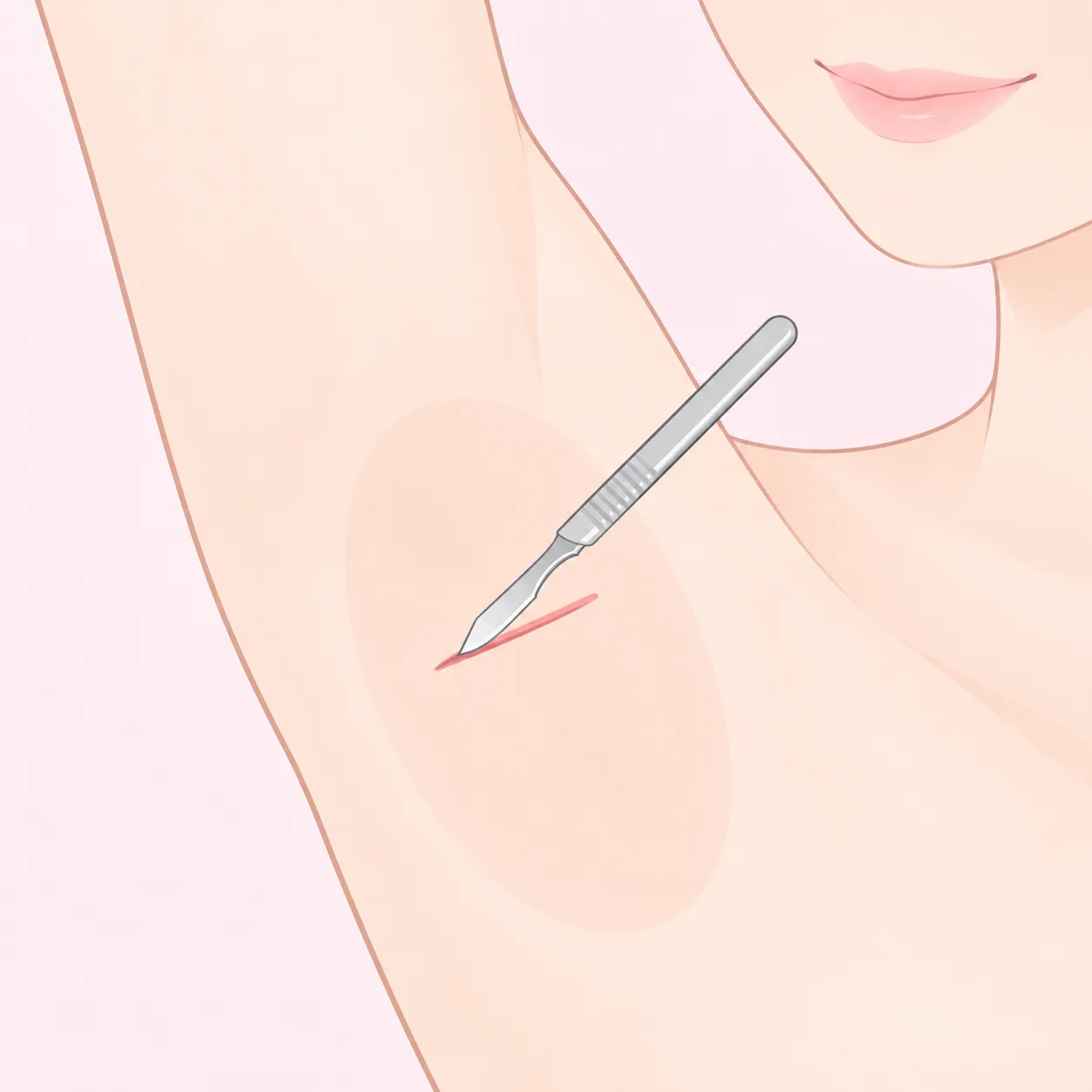 2. 切開