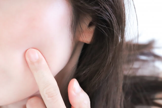 ニキビにはレモン汁