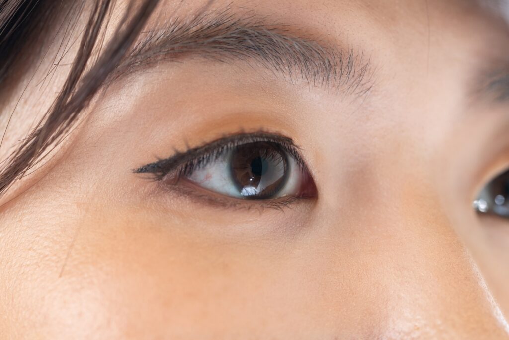 目の下の脱脂で脂肪を取りすぎるとどうなる?くぼみ・老け見えを防ぐポイント