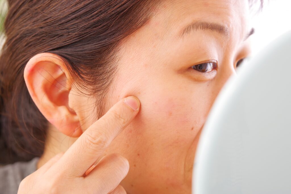 シミ取りレーザー後の赤み・かさぶたはいつまで?ダウンタイム徹底ガイド