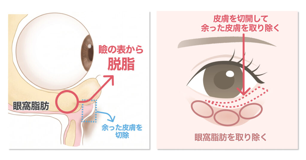下眼瞼切開法 (脱脂＋たるみ取り)