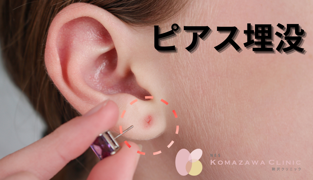 ピアス埋没（ピアストラブル） | 駒沢の皮膚科・形成外科・美容皮膚科