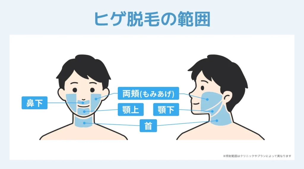 ヒゲ脱毛でおすすめのクリニック