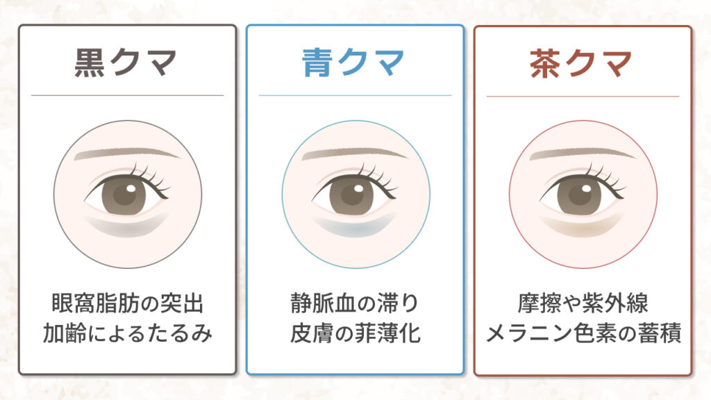 目の下のクマの種類と原因