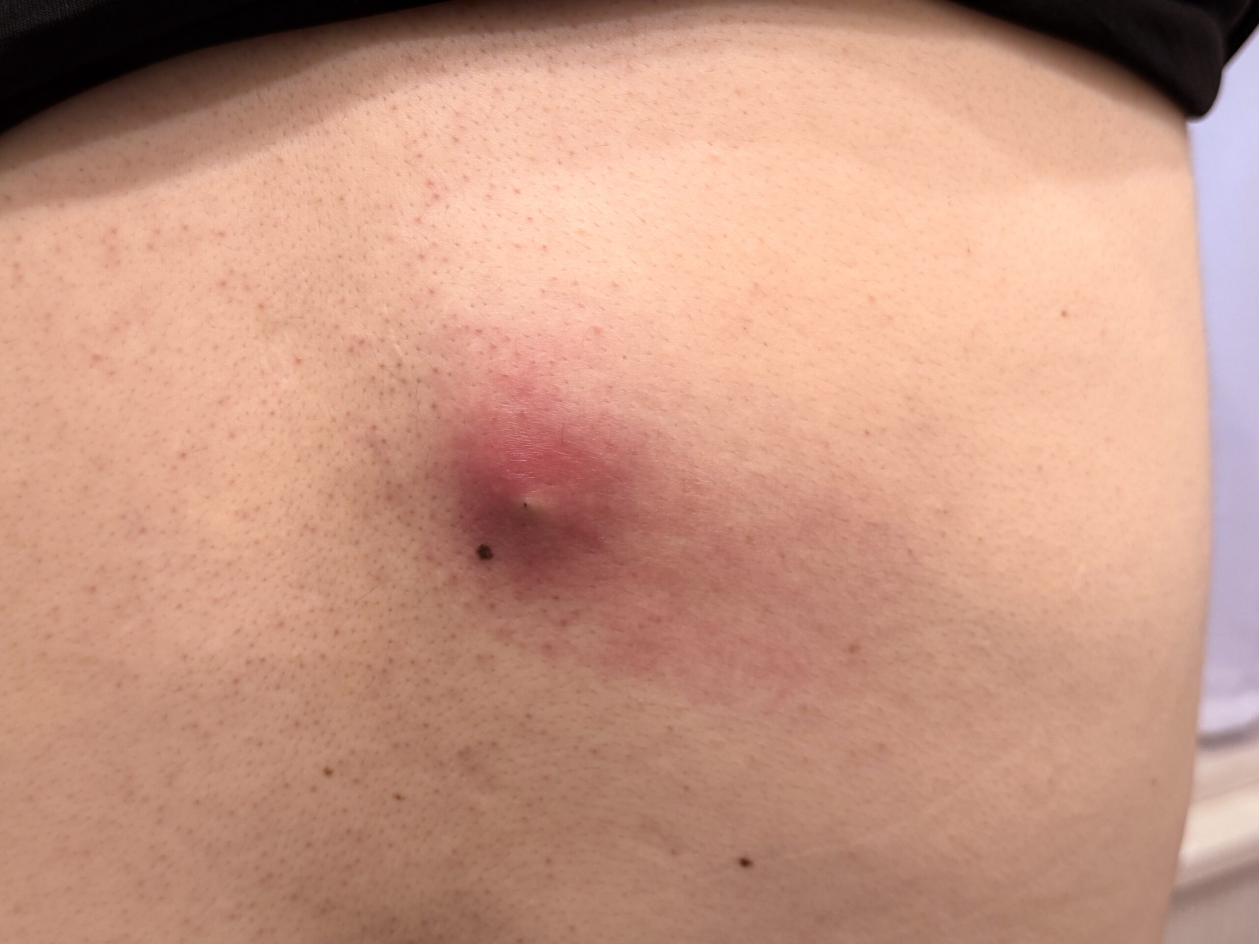 炎症を起こして赤く腫れた背中の粉瘤（アテローム）の写真