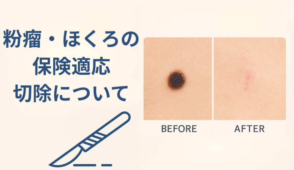 世田谷区駒沢の形成外科で粉瘤・ほくろ手術｜保険適用・費用・再発リスクまで解説