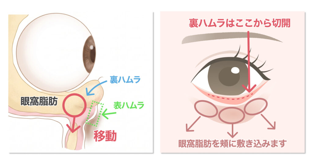 ハムラ法 (裏ハムラ法・表ハムラ法)