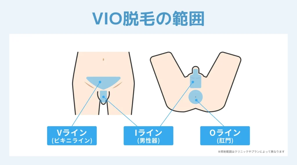 VIO脱毛でおすすめのクリニック