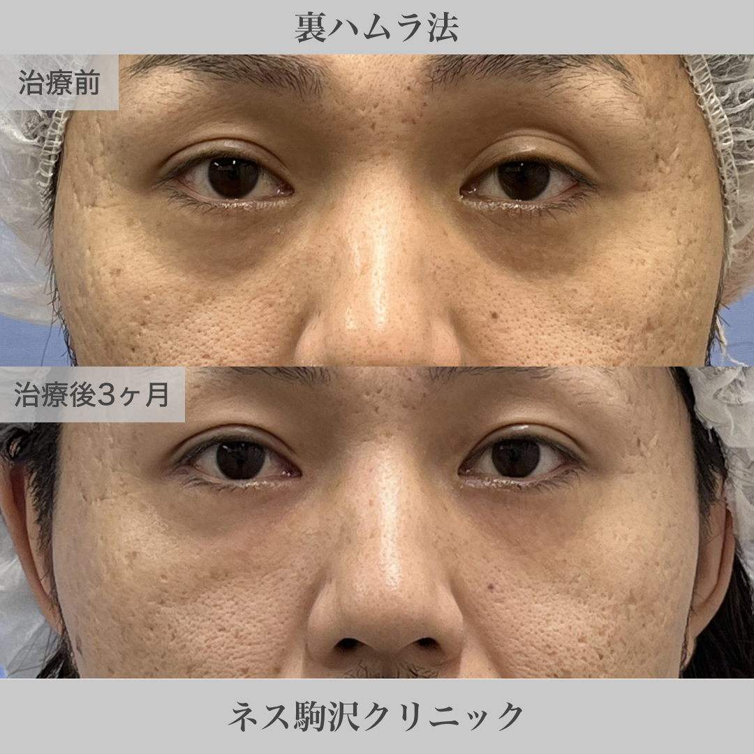 裏ハムラ法 症例1