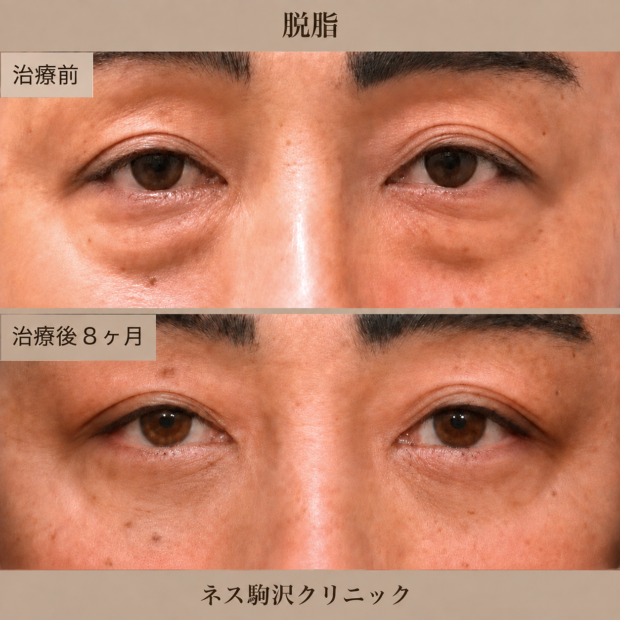 脱脂症例_3