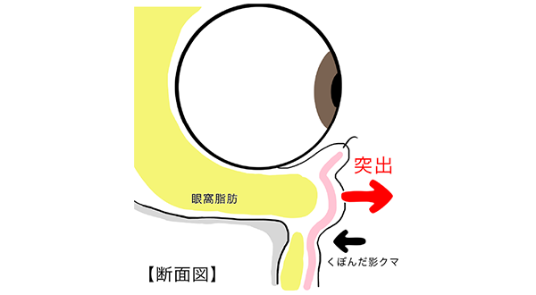 目の下のクマ・たるみとは