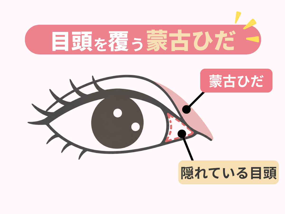 蒙古ひだが目頭を覆っている状態を示した図