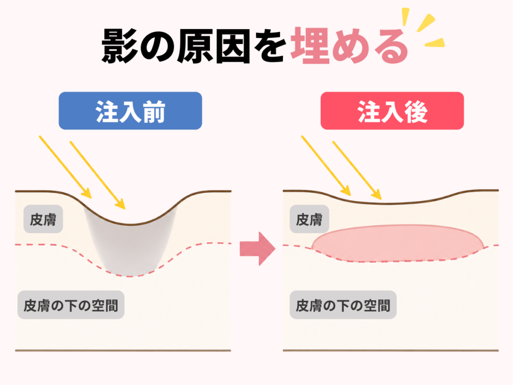 ヒアルロン酸注入前後の目の下の断面模式図。くぼみが埋まり影が浅くなる仕組みを示している