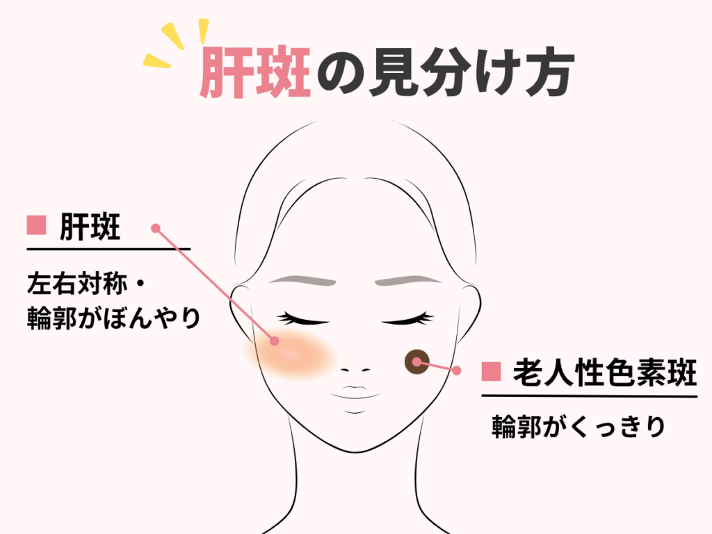 肝斑とは？シミ・ADMとの見分け方