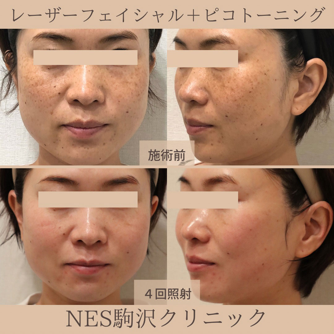 世田谷・駒沢でシミ取り・肝斑治療を提供しているネス駒沢クリニックのレーザーフェイシャルとピコトーニング症例写真