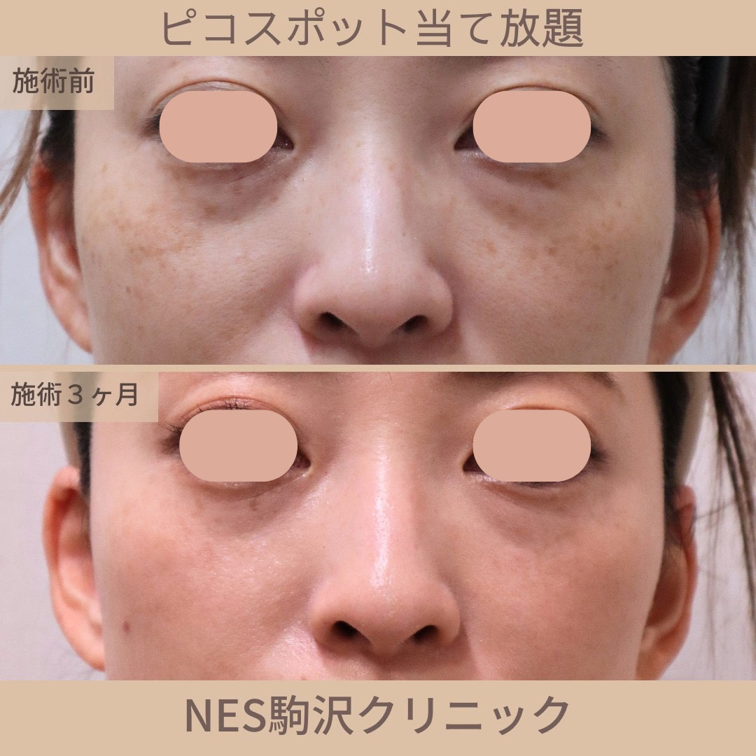 世田谷・駒沢でシミ取り・肝斑治療を提供しているネス駒沢クリニックのピコスポットシミ取り放題・当て放題の症例写真